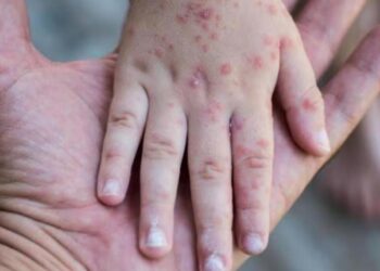 En el país hay 43 casos de sarampión, todos ellos importados: Ssa