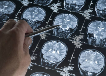 El alzhéimer es la principal causa de muerte en Japón desde 2015, según estudio