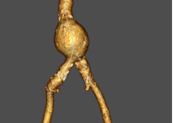 Aneurisma aórtico abdominal, amenaza silenciosa y desconocida potencialmente mortal