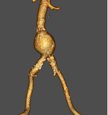 Aneurisma aórtico abdominal, amenaza silenciosa y desconocida potencialmente mortal