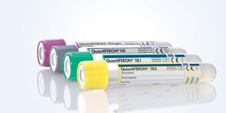 Necesario, fortalecer la detección oportuna de la tuberculosis latente