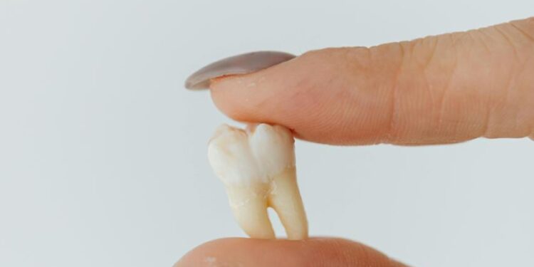 Muelas del juicio provocan dolor en 80% de la población mexicana