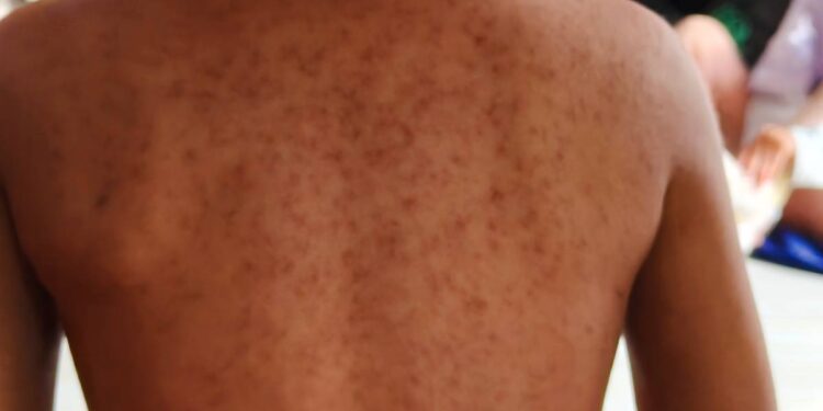 CDMX informa sobre alcaldías con más casos de sarampión y llama a no “estigmatizar”