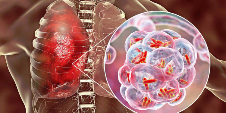 Tuberculosis: detectar a tiempo para frenar una epidemia silenciosa El arte de disfrutar con estilo y sentido.