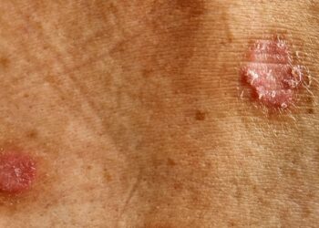 31 millones de personas en México viven con alguna enfermedad de la piel. ¿Cómo reconocer la Hidradenitis Supurativa?